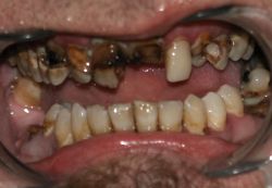 www.dental__health.com_images_badteeth_austin_rotten_teeth.jpg